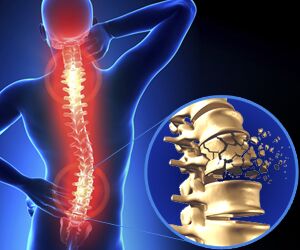 5 Common Spinal Injuries from Car Accidents